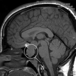 Mp glanda pituitară cu contrast, atunci când face ceea ce arată glanda pituitară a creierului, costul,