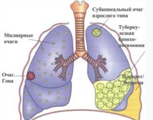 Remedii populare pentru tuberculoza pulmonară la adulți, tratament cu medicamente populare