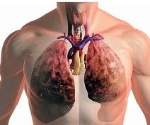 Remedii populare pentru tuberculoza pulmonară la adulți, tratament cu medicamente populare
