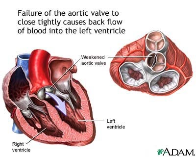 Insuficiență a valvei aortice - etiologie, patogeneză, imagine clinică (simptome),