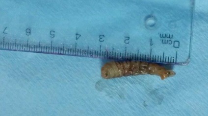 Un medic invitat neinvitat a scos un tip din ochiul unui vierme de 3 centimetri, umkra