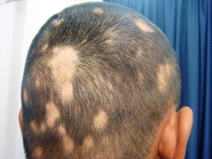 Focalizarea cauzată de alopecie (alimentară), tratamentul (copii și adulți)