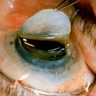 Transplantul corneei ochiului (keratoplastia) în clinica de ochi din Moscova