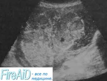 Determinarea gradului de maturitate a fătului prin ultrasunete (ultrasunete)