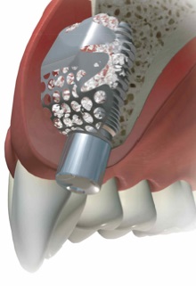 Caracteristicile tratamentului recesiunii gingiilor și implantarea dentară
