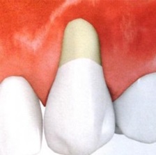 Caracteristicile tratamentului recesiunii gingiilor și implantarea dentară