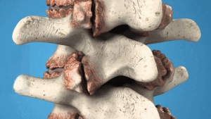 Osteofitele coloanei vertebrale toracice