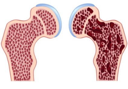 Osteopenia este ceea ce este, caracteristicile și cum să o tratați