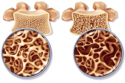 Osteopenia este ceea ce este, caracteristicile și cum să o tratați