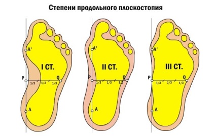 Плоско стъпало причини, симптоми, видове и етапи на плоско стъпало