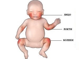 Чому з'являється висип на обличчі у немовляти, і як з нею боротися