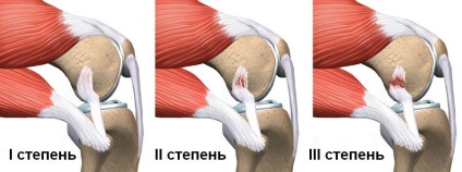 Deteriorarea aparatului ligamental al articulației genunchiului și tratamentul acestuia, ruptura ligamentelor articulației genunchiului