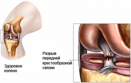 Deteriorarea aparatului ligamental al articulației genunchiului și tratamentul acestuia, ruptura ligamentelor articulației genunchiului