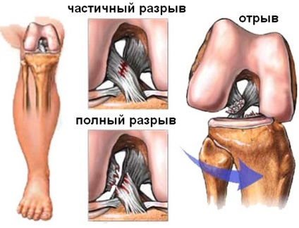 Deteriorarea aparatului ligamental al articulației genunchiului și tratamentul acestuia, ruptura ligamentelor articulației genunchiului