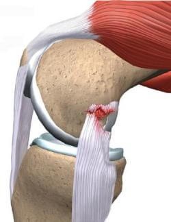 Deteriorarea aparatului ligamental al articulației genunchiului și tratamentul acestuia, ruptura ligamentelor articulației genunchiului