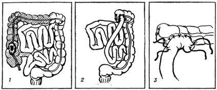 Hemicolectomia dreaptă