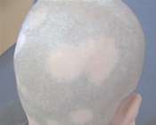 Cauzele alopeciei la copii, tratament