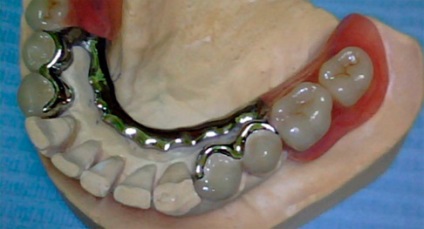 Protetikus fogászat