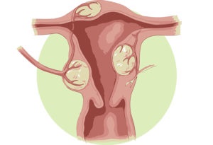 Psihosomaticii miomului uterului în motive psihologice ale femeilor
