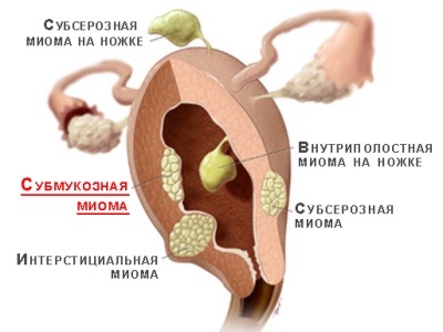 Psihosomatica caracteristicilor fibroamei uterine de influenta asupra patologiei