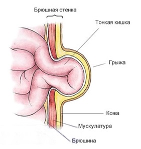 Hernia ombilicală după intervenție chirurgicală