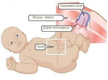 Hernia ombilicală după intervenție chirurgicală