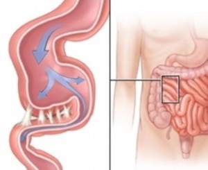 Hernia ombilicală după intervenție chirurgicală