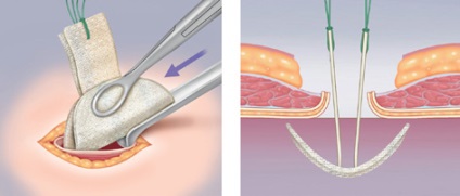 Hernia ombilicală după intervenție chirurgicală