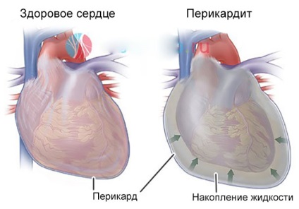 Simptome de cancer de inima, semne, tratament și prognostic