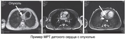 Simptome de cancer de inima, semne, tratament și prognostic