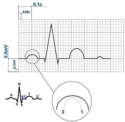 Explicarea complexului atrial p - atrial