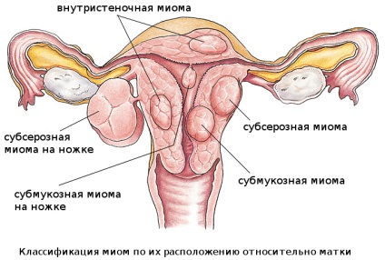 Stomacul crește în cauzele femeilor de ginecologie 6 întrebări despre simptomele fibromului uterin, diagnosticul și tratamentul
