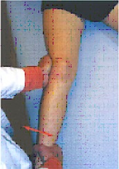 Ruptura ligamentului collateral medial (ruptura ligamentului lateral interior)