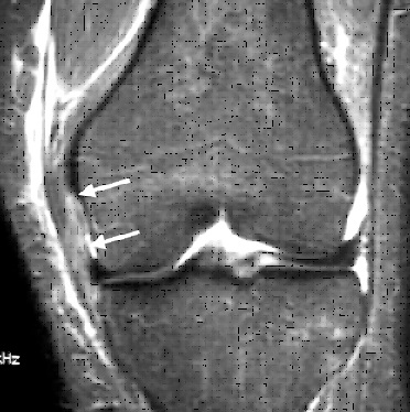 Ruptura ligamentului collateral medial (ruptura ligamentului lateral interior)