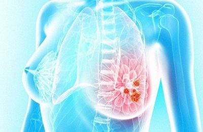Etapele și tipurile de descriere a clasificării cancerului de sân și modul de determinare a gradului de malignitate