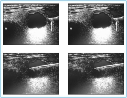 Aplicarea unei biopsii a acului cu finele ac din neoplasmul gâtului sub controlul scanării cu ultrasunete