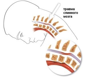 Leziuni ale nașterii coloanei vertebrale și ale măduvei spinării și tratamentul dobândit și recuperarea după traume