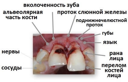 Leziuni cauzate de dinți, prim ajutor pentru traume dentare acute și opțiuni de tratament - informații despre simptome