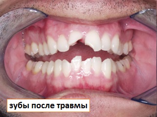 Sérülés a fogakra, elsősegély az akut fogászati ​​traumára és a kezelési lehetőségekre - tüneti információ