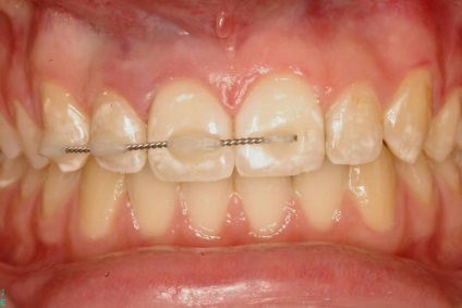 Sérülés a fogakra, elsősegély az akut fogászati ​​traumára és a kezelési lehetőségekre - tüneti információ