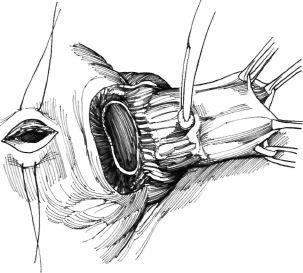 Eliminarea diverticulului vezicii urinare, hyman f