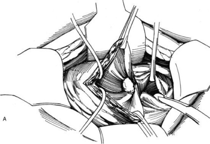 Eliminarea diverticulului vezicii urinare, hyman f