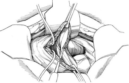 Eliminarea diverticulului vezicii urinare, hyman f