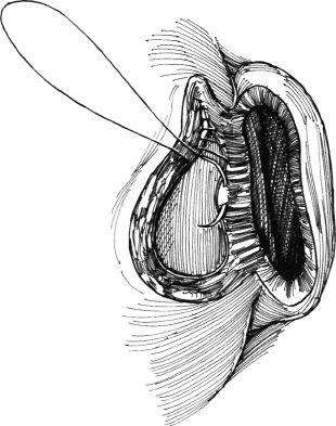 Eliminarea diverticulului vezicii urinare, hyman f