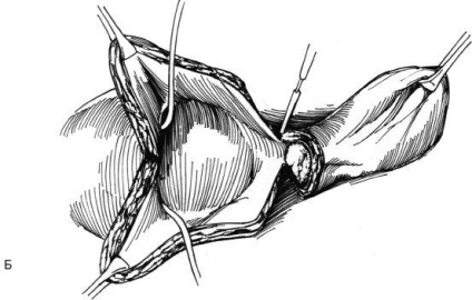 Eliminarea diverticulului vezicii urinare, hyman f