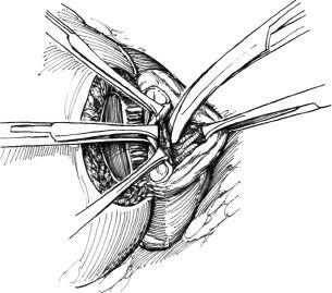 Eliminarea diverticulului vezicii urinare, hyman f