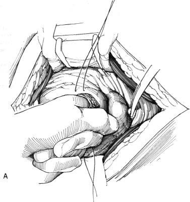 Eliminarea diverticulului vezicii urinare, hyman f