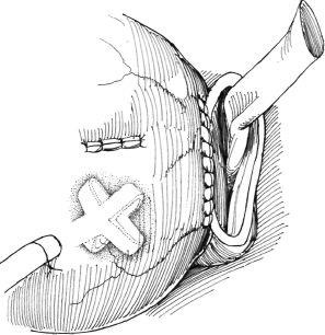 Eliminarea diverticulului vezicii urinare, hyman f