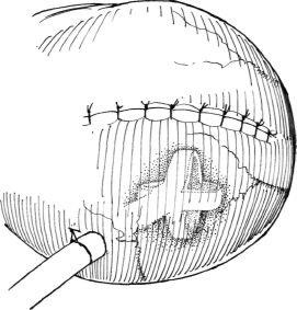 Eliminarea diverticulului vezicii urinare, hyman f