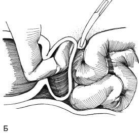 Eliminarea diverticulului vezicii urinare, hyman f